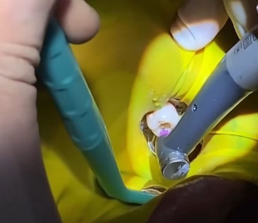 Endodontic Treatment